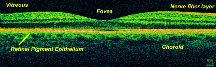 An image of an OCT scan, the fovea is the center of the macula.