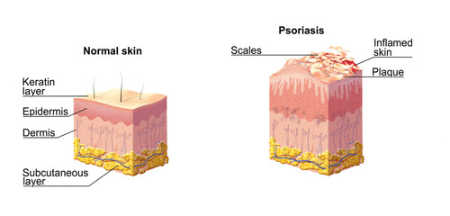 The Buildup of Skin Cells Leading to Psoriasis