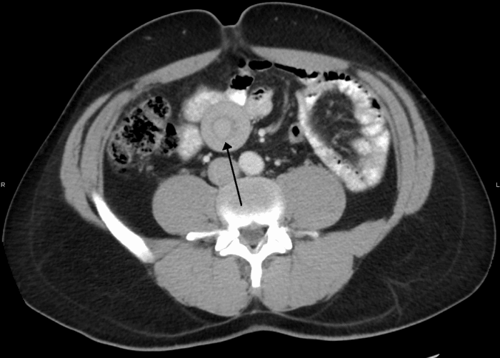 A CAT scan showing a case of intussusception. The circular target sign indicates where one part of the bowel folded into another.