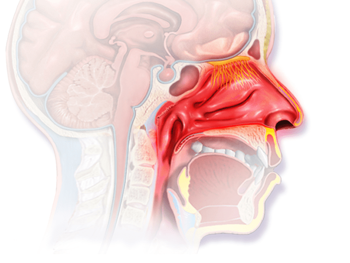 El aumento del flujo sanguíneo es la causa más común de hemorragias nasales durante el embarazo. 