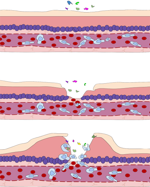 Inflammation is a process by which the body's white blood cells and substances they produce protect us from infection with foreign organisms, such as bacteria and viruses.