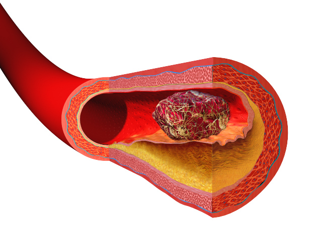 alguns alelos arcaicos contribuem para uma tendência a formar coágulos de sangue facilmente. Isto pode levar a problemas com trombose venosa profunda em alguns indivíduos.