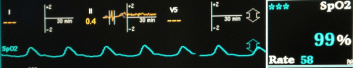 The pulse oximeter shows the heartbeats and displays the percent saturation of the blood with oxygen.