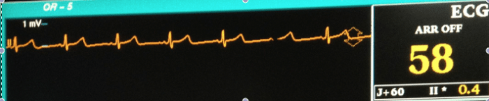 The EKG displays the heart rate and rhythm and gives other information about the health of the heart, as well.