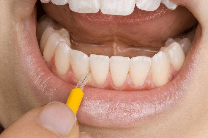 An interdental brush removes plaque from between your teeth that even an electric toothbrush cannot reach.