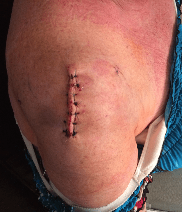 This photo was taken immediately after the surgical dressing was removed on the third day post-op. Because I am allergic to metal staples, I have to have hand sewn stitches. Love that because it makes for a much "prettier" scar.