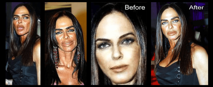 Michaela Romanini: The first two photos were taken after her surgeries. The last two show her face before surgery and after.