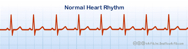 ♥ How to Beat Your Atrial Fibrillation ♥ An Introduction to A-Fib ...