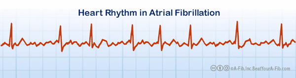 Compare the above pattern to the irregular, rapid pattern of the heart in A-Fib.