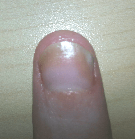 Nail Psoriasis with Fungus (My Left Thumb Nail) Recently treated with steroid injections, and daily with my nail oil, and Vicks.
