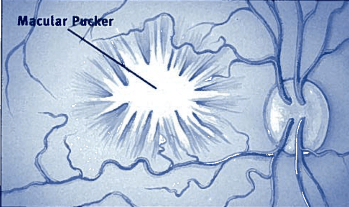 A diagram of what the scar tissue looks like on the retina. Also known as the epiretinal membrane.