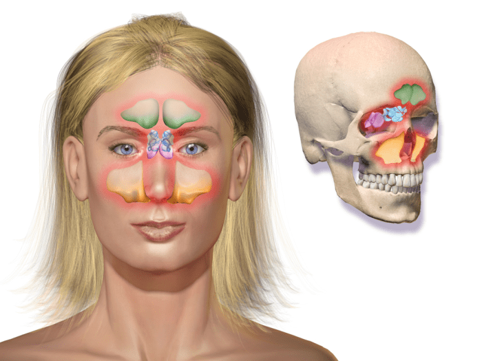 Areas of the face affected by sinus headache.
