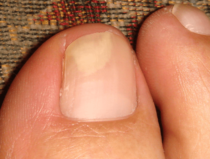 Still remains the same weeks after using the topical treatment. In fact, it was only getting better after I switched to wearing slippers for more "breath-ability" on my feet.