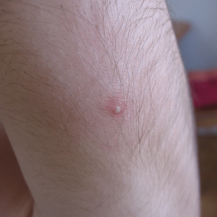 Acne vulgaris, in this case on the arm, can also appear on the thighs or buttocks.