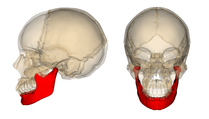 They "broke" the mandible on both sides and extended it by inserting pieces of bone taken from my right hip.