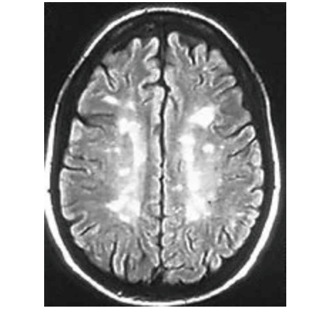 This is a 2010 MRI with Multiple Sclerosis brain lesions. The doctors stopped counting after 23 lesions.