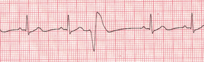 Cardiac Arrhythmia: Premature Ventricular Contractions (PVC) - When The ...