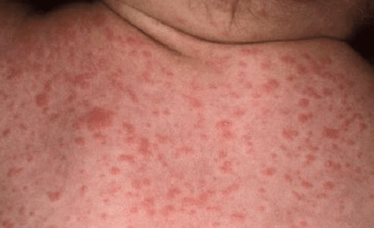 Lamictal Rash Symptoms Treatment Images HubPages