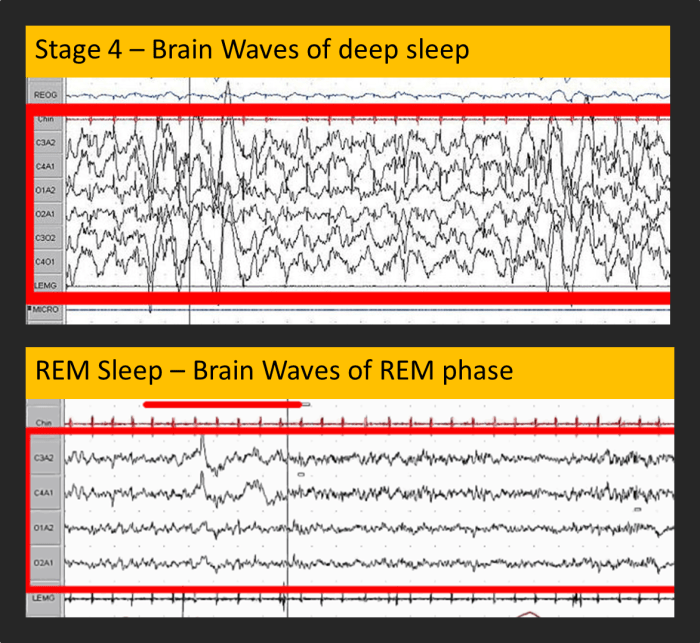 30 seconds of EEG data for patients in Stage 4 sleep (top) and REM sleep (bottom)