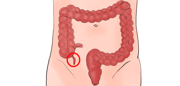 Appendicitis is an inflamed appendix and can cause abdominal tenderness among other symptoms.