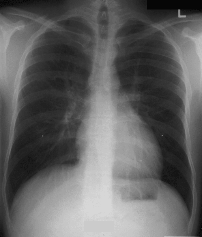 Common symptoms of respiratory diseases are cough, sputum production, chest pain, breathlessness, hemoptysis and wheeze.