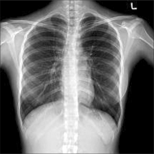 Oxygen from inhaled air passes through the alveoli into the bloodstream and oxygenated blood is returned to the left heart via the pulmonary veins. The bronchial (systemic) system carrier arterial blood from the descending aorta to oxygenate lung.