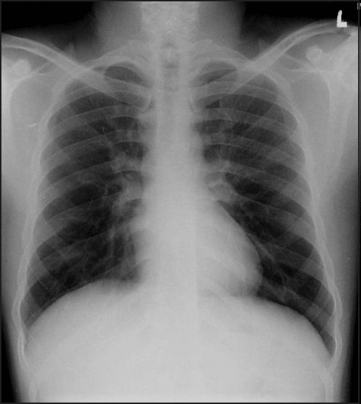 Gas exchange occurs in the alveolus where capillary blood flow and inspired air are separated only by thin wall composed mainly of type 1 pneumocytes and capillary endothelial cells and the capillary and alveolar basement membranes are fused as one.