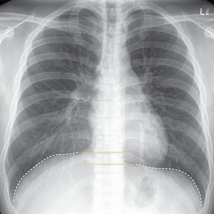 Within the Lungs and Bronchi branch again, forming secondary and tertiary bronchi, then smaller bronchioles and finally terminal bronchioles ending at the alveoli.