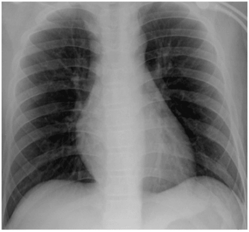 The lung has a dual supply: pulmonary (venous blood) and systemic (arterial blood). The pulmonary circulation delivers deoxygenated blood to the lungs from the right side of the heart via the pulmonary artery.