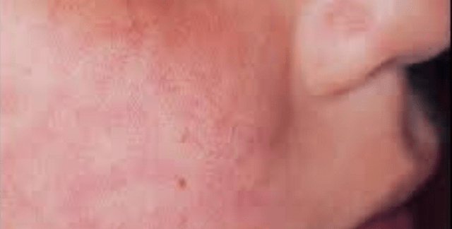 HIV Skin Rash - Images, Causes, Symptoms, Treatment - HubPages