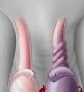 An Illustration Showing Testicular Torsion On The Right And A Normal Spermatic Cord On The Left.
