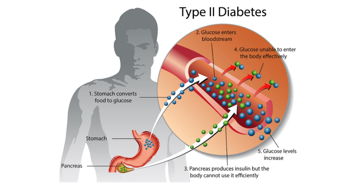 Insulin and glucose production in type 2 diabetes: Insulin (green dots) is produced in the pancreas, and acts with glucose (blue dots) to regulate energy in the body's cells.