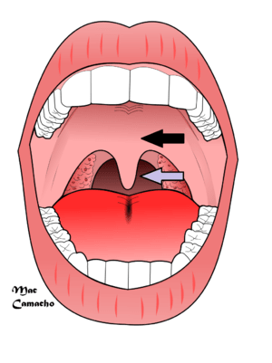 Snoring is most often caused by the vibration of the uvula (grey arrow) and the soft palate (black arrow)