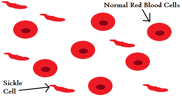 Sickle Cell is characterized by hard, stringy hemoglobin that causes misshapen red blood cells which can easily burst before performing its job.
