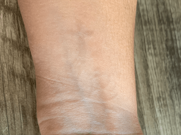 As mentioned, I did not finish the treatment and like the faded look. This photo is after 11 total treatments and 2 years post laser treatment of any kind.
