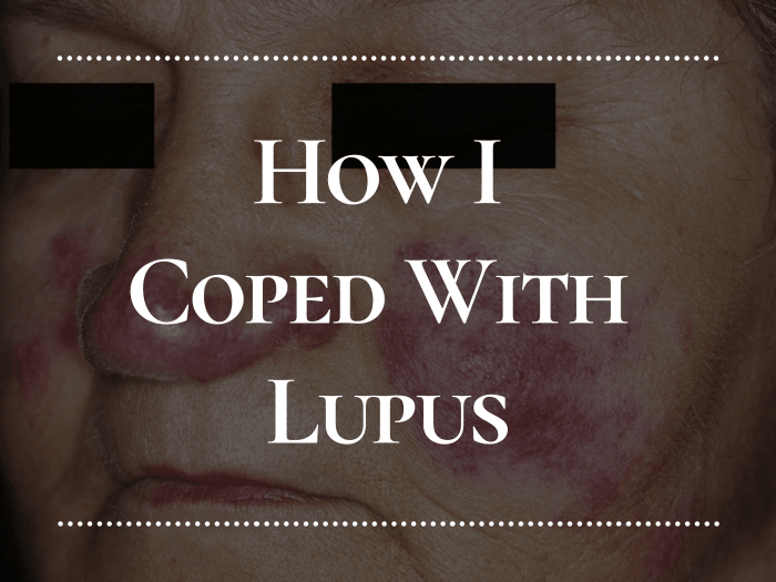 My experience with lupus: when I first got it, how it affected me, how I treated it, and my life today.
