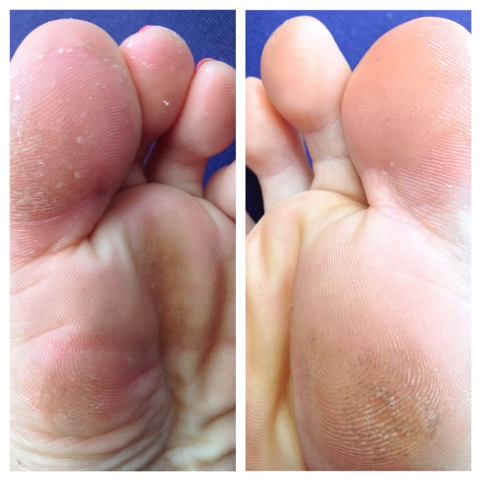 How To Get Rid Of Athlete S Foot On Toes