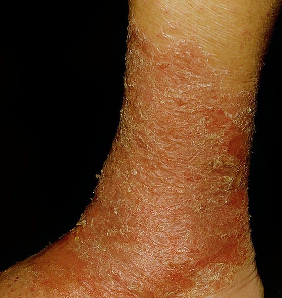 stasis-dermatitis-pictures-symptoms-causes-treatment-diagnosis