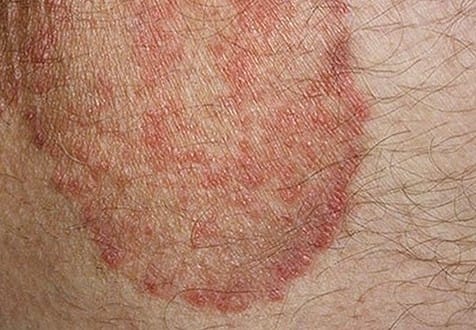 Itchy Skin Rash - Pictures, Causes, Symptoms, Treatment - HubPages