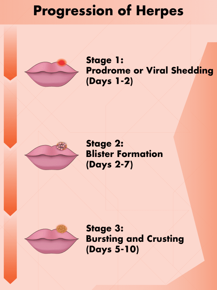 How To Tell The Difference Between Herpes And Pimples (With Photos) (2022)