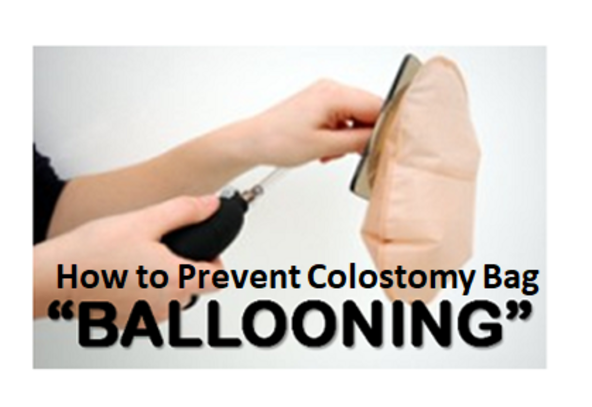 How I Prevent Colostomy Bag Ballooning