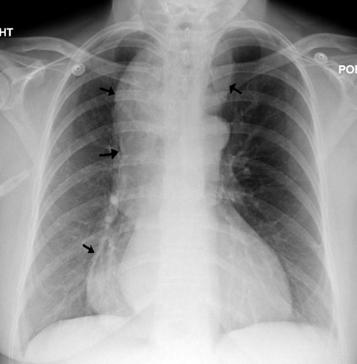 A chest x-ray (CXR) showing achalasia (arrows point to the outline of the massively dilated esophagus)