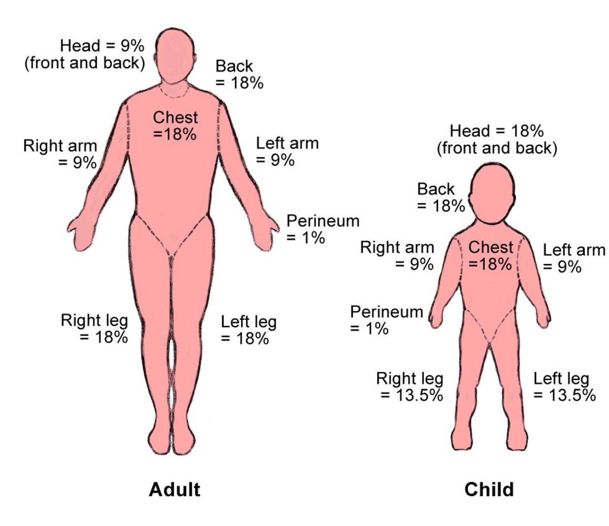 Burn percentage chart by body region for adults and children.