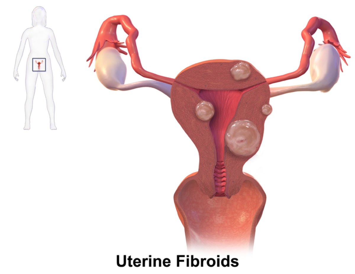 Although non-cancerous, fibroids can still cause a great deal of pain.
