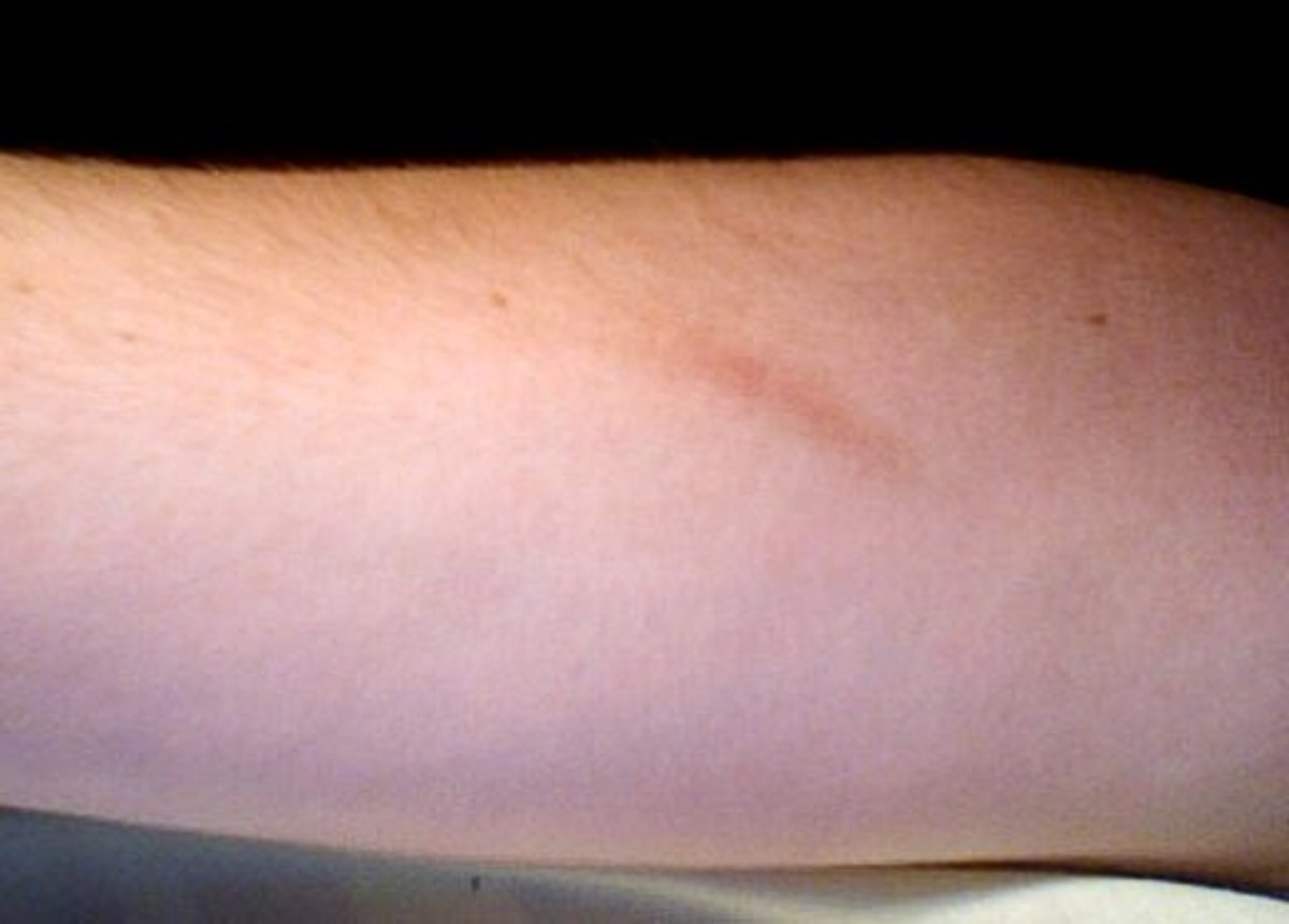 A minor scar one year after the injury that caused it