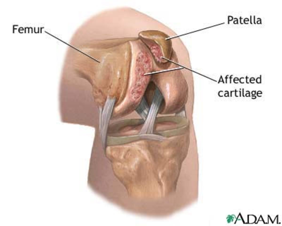 Cartilage Damage from Chondromalacia