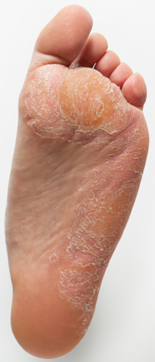 Tips for Successfully Removing Corns & Callusus on the Feet