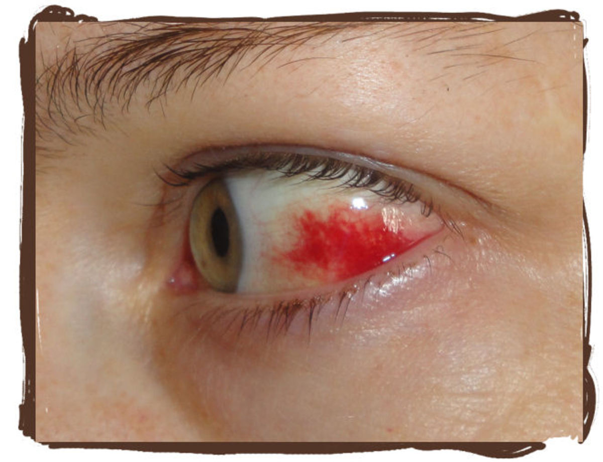 Why Did My Eye Turn Red? Subconjuctival Hemorrhage