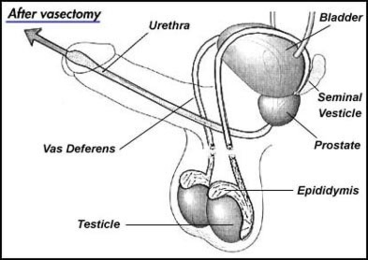 Male genitals after a vasectomy