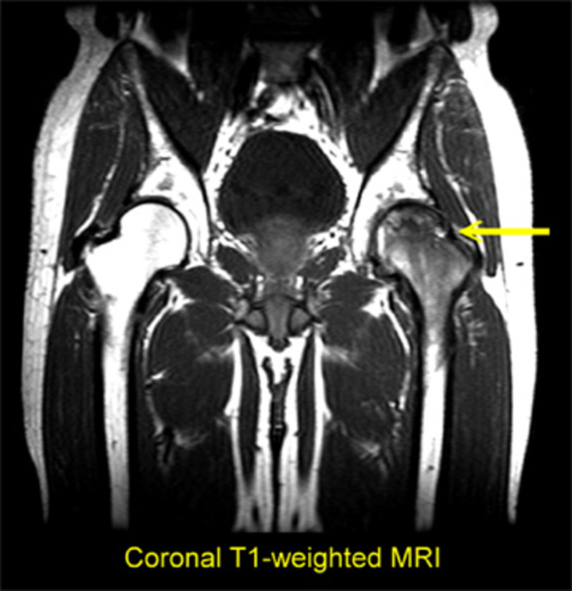 MRI of stage III AVN